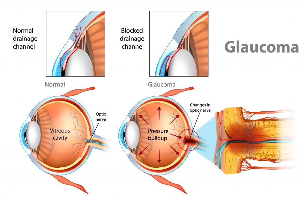 Glaucoma illustration showing normal drainage and a blocked drainage channel