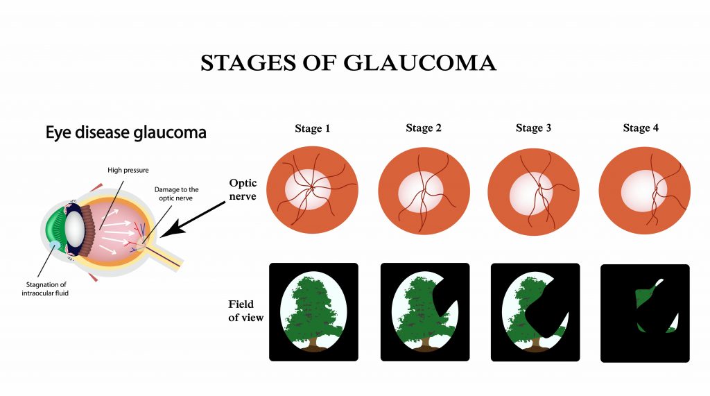 Glaucoma illustration showing the structure of the eye and the field of vision with glaucoma