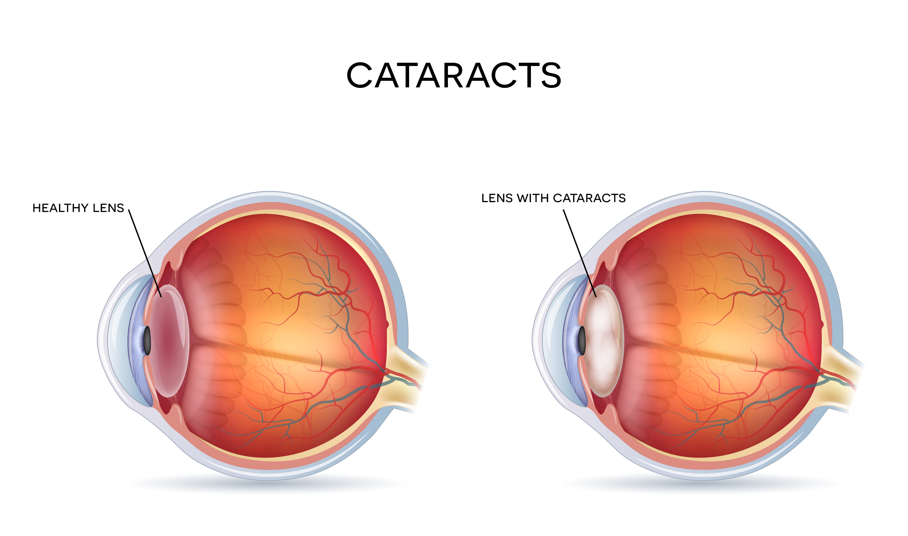 Side view image of cataracts in an eye