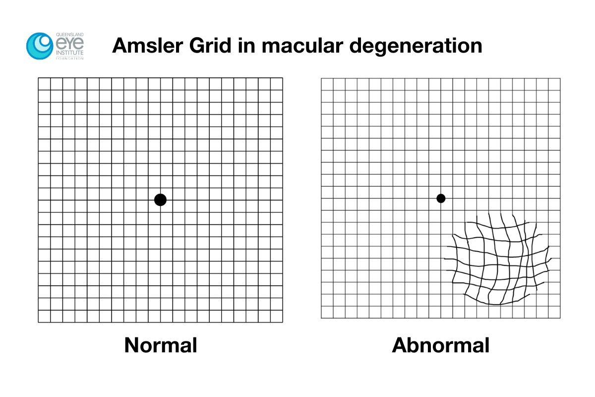 A graphic with two grids. One grid has perfectly parallel lines and is labelled 'normal', The other has a section with distorted lines in one segment and is labelled 'abnormal'.