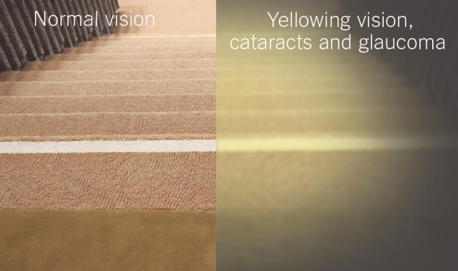 Two images of carpeted stairs, with one showing how the stairs would appear to someone with yellowing vision, cataracts and glaucoma