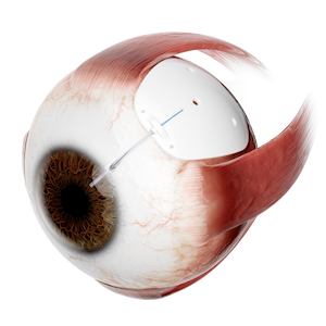 Human eyeball with shield-like device and drainage shunt attached